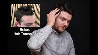 Gareth's Temple Points Hair Transplant Experience | Dr Mark Tam