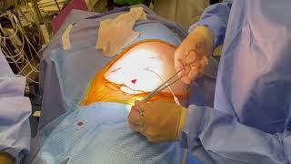 Cerfolio Tips: How Safely Remove Chest Tube in OR with small Air Leak after Lobectomy