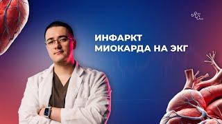 Инфаркт миокарда на ЭКГ