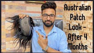 Hair patch in Durgapur | best hair replacement center |