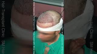 FUE Hair Transplant Journey | SM Hair Transplant Clinic | Panipat | Shamli