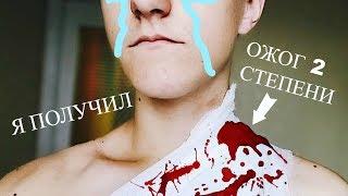 Я ПОЛУЧИЛ ОЖОГ 2 СТЕПЕНИ