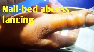 Nail-bed Abcess draining ‼️ || #whatilearntoday || pus || eiter || صديد