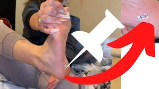 Teen Got a Tack Stuck in Her Foot  | Not a Prank