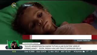 #Yemen'deki iç savaş sırasında 5 yaşın altındaki 85 bin çocuk açlıktan hayatını kaybetti