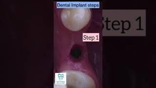 Dental Implant Steps #shorts