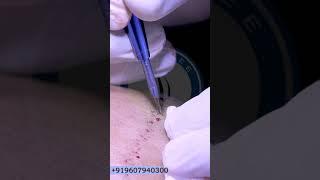 Sapphire FUE Hair Transplant Process | original pattern technique  -HFHG Clinic | NEW FUE Transplant