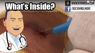 What's Inside the Onion Cyst? | John Gilmore M.D.