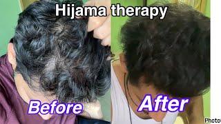 Hijama therapy for hair growth my ￼ experience #educational #hairgrowth