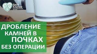 Камни в почках без операции.  Лечение камней в почках без операции. Бест Клиник.