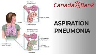 Aspiration Pneumonia