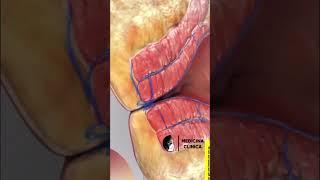 Cirurgia de Hemorróida #shorts