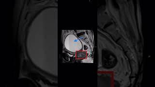 Cervical carcinoma with Hematometra