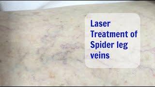 Laser Treatment for Spider Veins - Cosmetic Institute of Australia