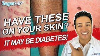 12 Diabetic Skin Problems & Top Signs of Diabetes on The Skin!