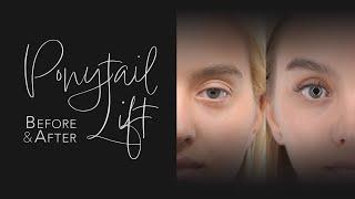 Ponytail Lift Plastic Surgery Before & After | The Best Facelift?