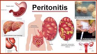 peritonitis