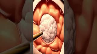 Brain tumor Surgery and treatment | glioma #shorts #glioma #astrocytomas