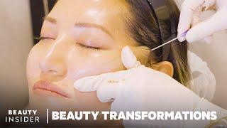 How Nonsurgical Face-Lifts Work With PDO Threads | Beauty Transformations | Insider Beauty