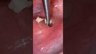 The Most Disgusting Tonsil Stones EVER?!