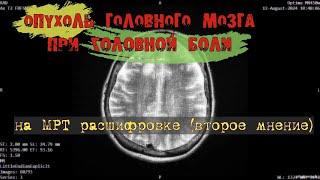 Дисциркуляторная ЭНЦЕФАЛОПАТИЯ fazekas 2 и ОПУХОЛЬ головного мозга на МРТ РАСШИФРОВКЕ второе мнение