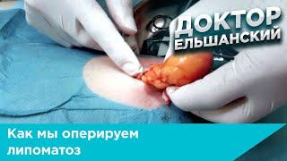 Как мы оперируем липоматоз