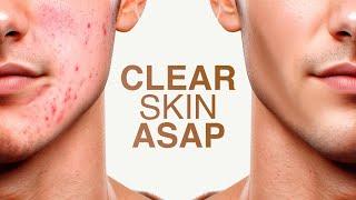 how to get clear skin for guys asap (full guide)