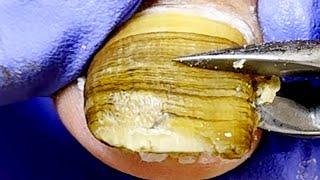 Cut Open The Onychomycosis That Is Full Of Debris And Clean It Thoroughly【Xue Yidao】