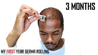 Derma Roller Hair Regrowth Results 3 Months | Month by Month Progress