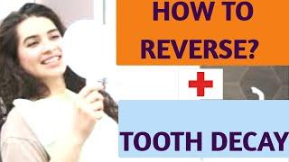 Cavity natural home remedies English |  | tooth decay prevention |  #tootherosion #cavityprevention