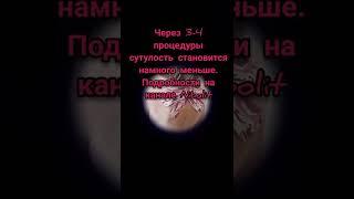 Выровнять человека легко | Кифоз | сколиоз | сутулость |