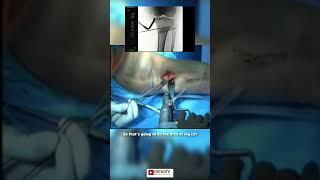 High tibial Osteotomy Guide wire placement - Dr Dinshaw Pardiwala