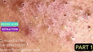 Mụn ẩn đầy mặt|Dermatologist,pimples,whitehead blackhead,anti acne,hidden acne removal 0985773391 p1