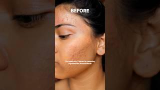 One serum for pigmentation around mouth | Remove pigmentation around mouth #shorts #pigmentation