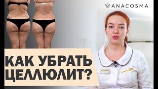 ⭐️ КАК ИЗБАВИТЬСЯ ОТ ЦЕЛЛЮЛИТА на попе и ногах? ⭐️ В домашних условиях⭐️Процедуры от целлюлита