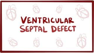 Ventricular septal defect (VSD) - repair, causes, symptoms & pathology