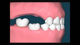 Dental Video of Lower Over-eruption