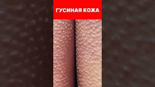 Как лечить ГУСИНУЮ КОЖУ? Просто используй эти средства