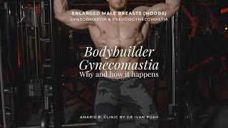 Bodybuilder Gynecomastia | Amaris B. Clinic by Dr Ivan Puah