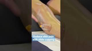 Reduce shin pain and increase ankle movements with dry cupping