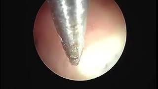 Dr/ waleed almery Hystroscopic metroplasty