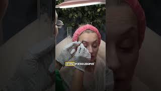 #Ботулинотерапия — это отличное решение для тех, кто хочет выглядеть свежо и молодо!  #косметолог