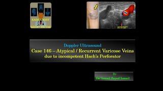 Ultrasound Case 146 - Atypical Varicose Veins due to Refluxive Hach Perforator