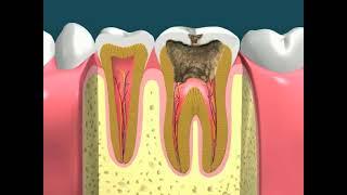 Dental Video of Cavity Progression