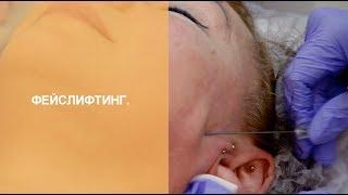 Процедура Facelifting