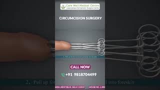 ZSR Circumcision Surgery in Delhi: A Step-by-Step Animated Guide | Circumcision Surgery Cost #shorts