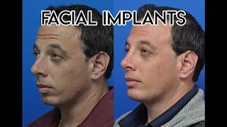 Facial Implants