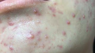 Make your Acne Treatment Huong Da Nang#520  | acne 2023