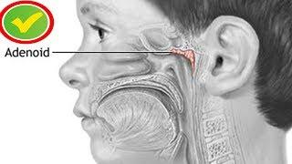Аденоиды - лечение народными средствами