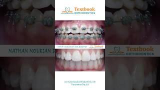This patient was in braces for 30 months w another orthodontist, but wasn't seeing results.